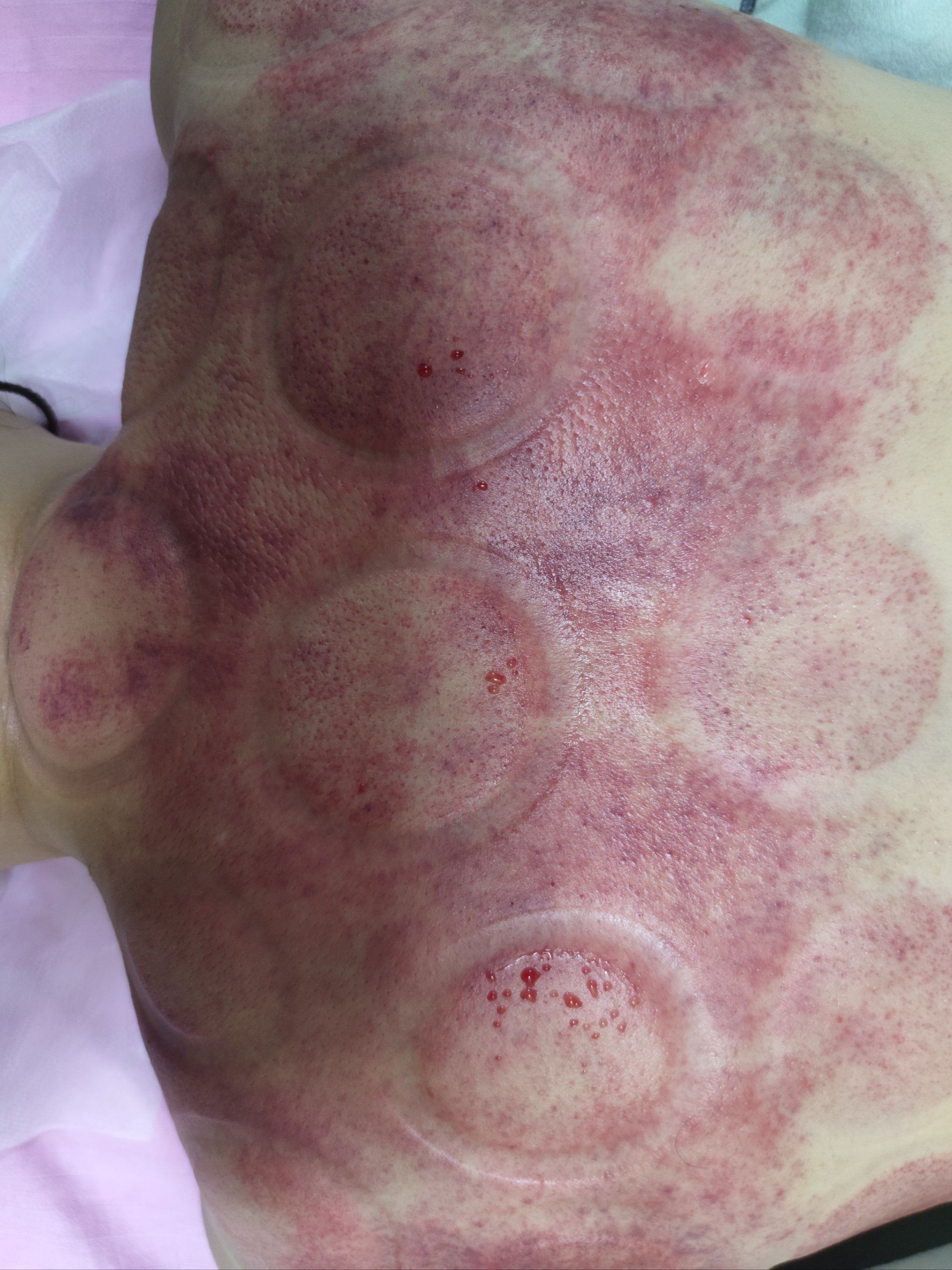 拔罐疗法,中医也能时尚!