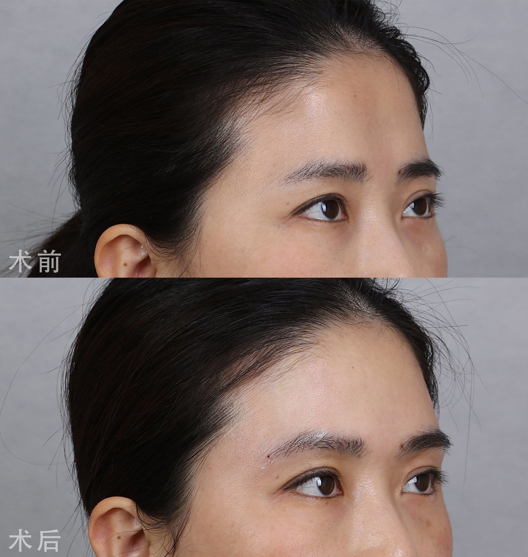 眉弓注射,玻尿酸打眉弓