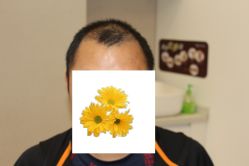 -大麦微针植发丨全国连锁
