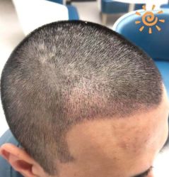 -大麦微针植发丨全国连锁