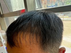 -碧莲盛·不剃发植发