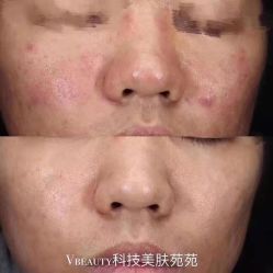 -苑苑vbeauty科技美容SPA