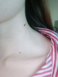 -痣缘宫