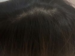 -碧莲盛·不剃发植发