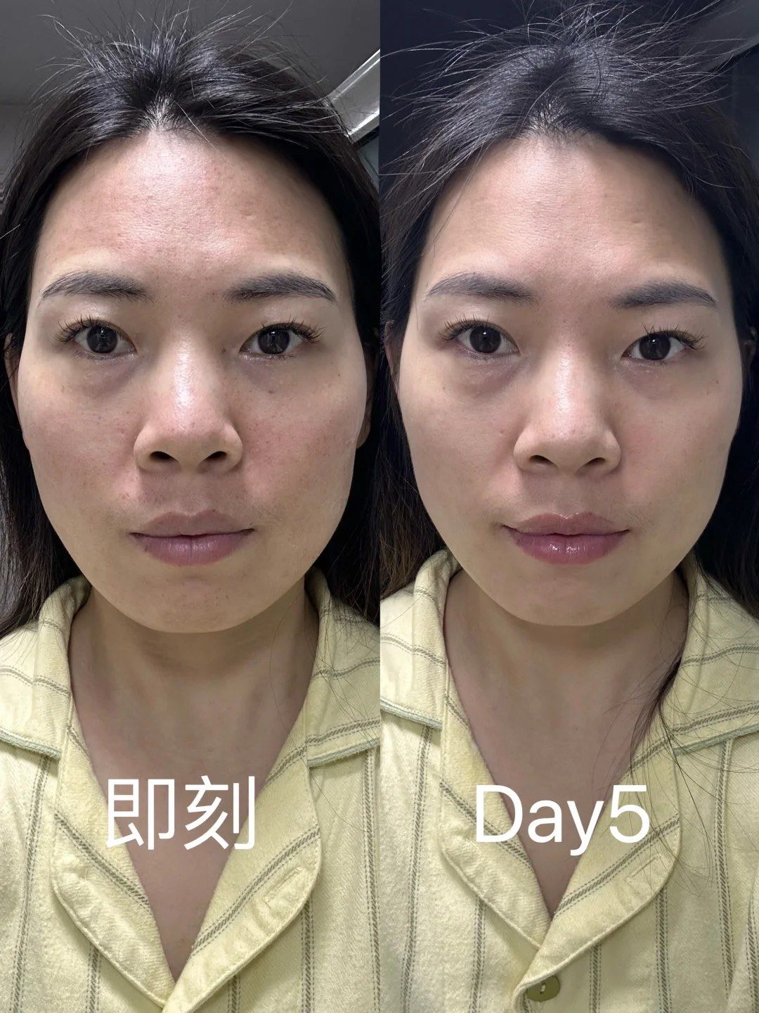 黄金微针真的可以冲