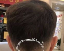 -大麦微针植发全国连锁