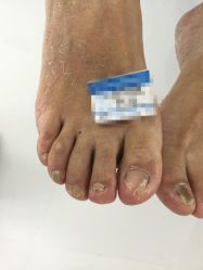 点击看大图 -派恩宜灰指甲鸡眼嵌甲手足癣