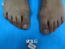 -德哥灰指甲脚气甲沟炎跖疣护理
