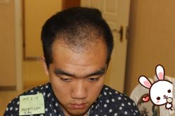 点击看大图 -大麦微针植发丨全国连锁