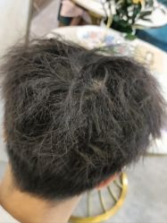 -碧莲盛·不剃发植发