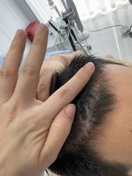 -大麦微针植发丨全国连锁