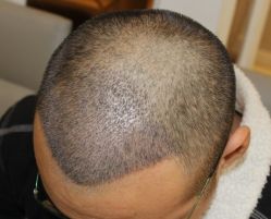 -大麦微针植发丨全国连锁