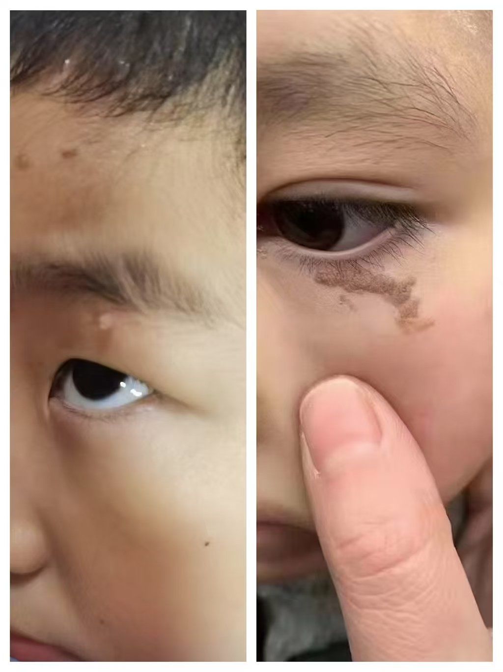 😱😱😱为什么就连小孩都有疣?
