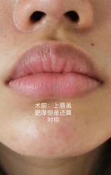 体验前-广州美莱医疗美容医院