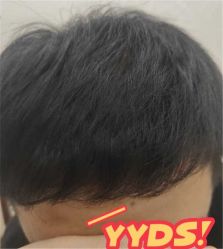 -大麦微针植发丨全国连锁