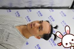 点击看大图 -大麦微针植发丨全国连锁