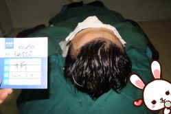 点击看大图 -大麦微针植发丨全国连锁