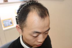 点击看大图 -大麦微针植发丨全国连锁