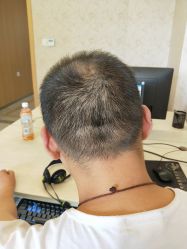 点击看大图 -大麦微针植发丨全国连锁