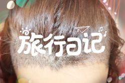 -大麦微针植发全国连锁