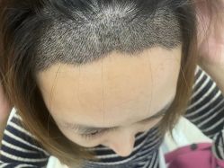 点击看大图 -碧莲盛·不剃发植发