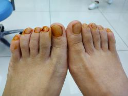 -派恩宜灰指甲鸡眼嵌甲手足癣