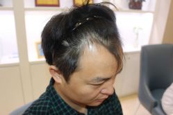点击看大图 -大麦微针植发丨全国连锁