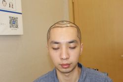 点击看大图 -大麦微针植发丨全国连锁