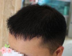 -大麦微针植发丨全国连锁