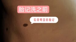 -净肤洗纹身
