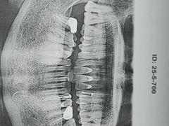 -上海仁爱医院口腔科 · 种植