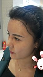 -大麦微针植发丨全国连锁