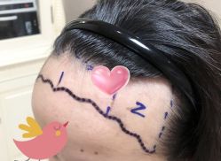 -大麦微针植发全国连锁