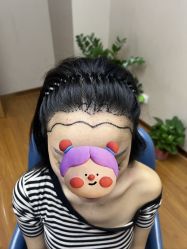 体验前-大麦微针植发全国连锁