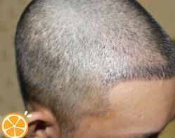 -大麦微针植发丨全国连锁