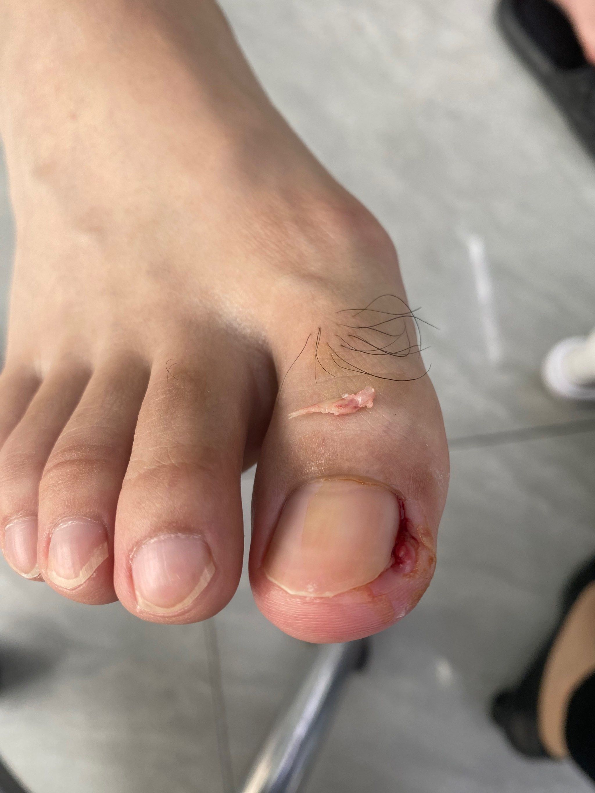 甲沟炎的痛,立马解决#脚指甲往肉里长怎么