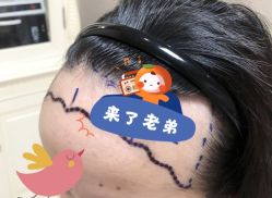 -大麦微针植发全国连锁