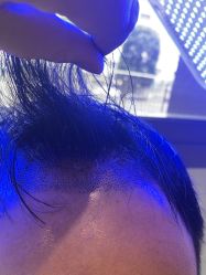 -碧莲盛·不剃发植发