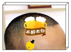 -大麦微针植发全国连锁