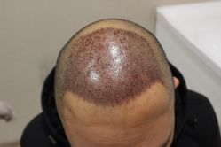 点击看大图 -大麦微针植发丨全国连锁