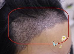 -大麦微针植发全国连锁