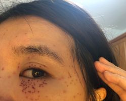 -美丽人生祛斑扁平疣汗管瘤中心
