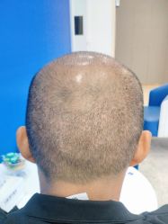 -大麦微针植发全国连锁