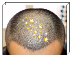 -大麦微针植发全国连锁