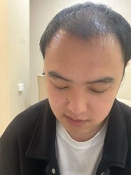 -大麦微针植发全国连锁