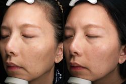 体验后-深圳芙必优医疗美容·抗衰中心