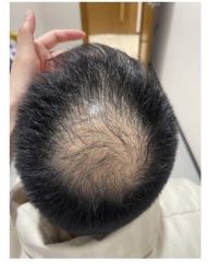 -大麦微针植发全国连锁