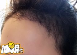 -大麦微针植发丨全国连锁