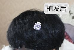 -大麦微针植发全国连锁