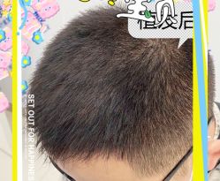 -大麦微针植发全国连锁